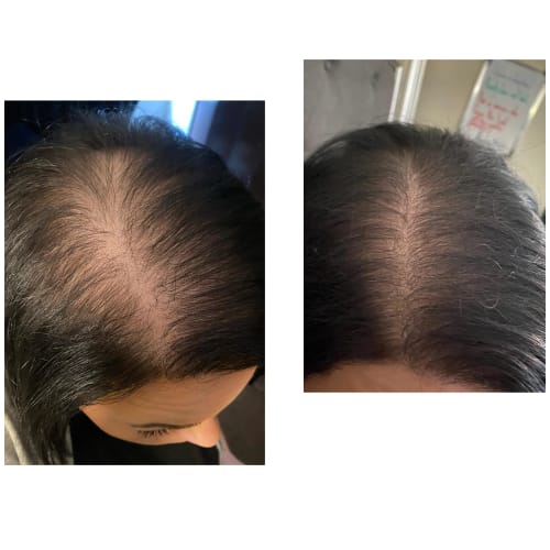 Customer photo review of Minoxidil High Strength (5%) SOLUTION, 3x60ml pack