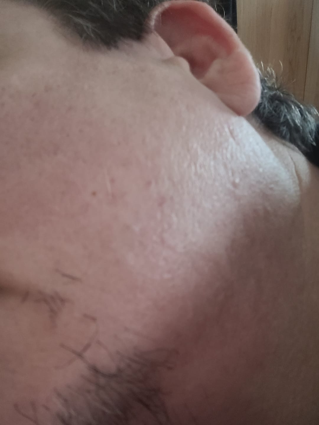 Customer photo review of PDRN Micro-Infusion Skin Booster