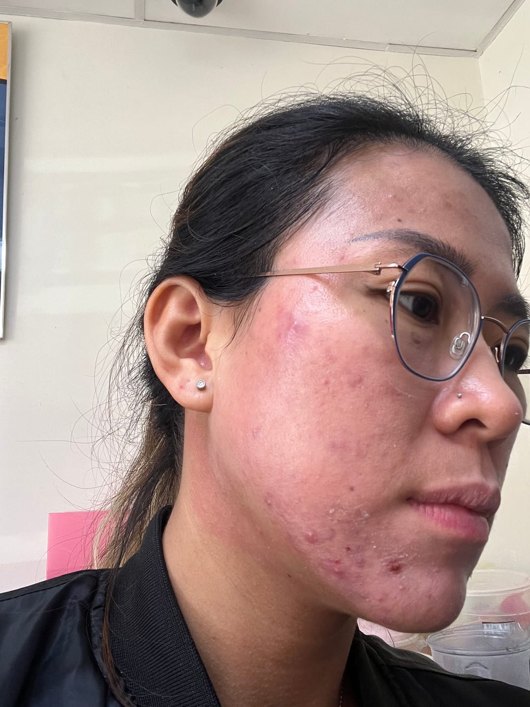 Customer photo review of Salicylic Acid Acne-Clearing 4-Piece Set
