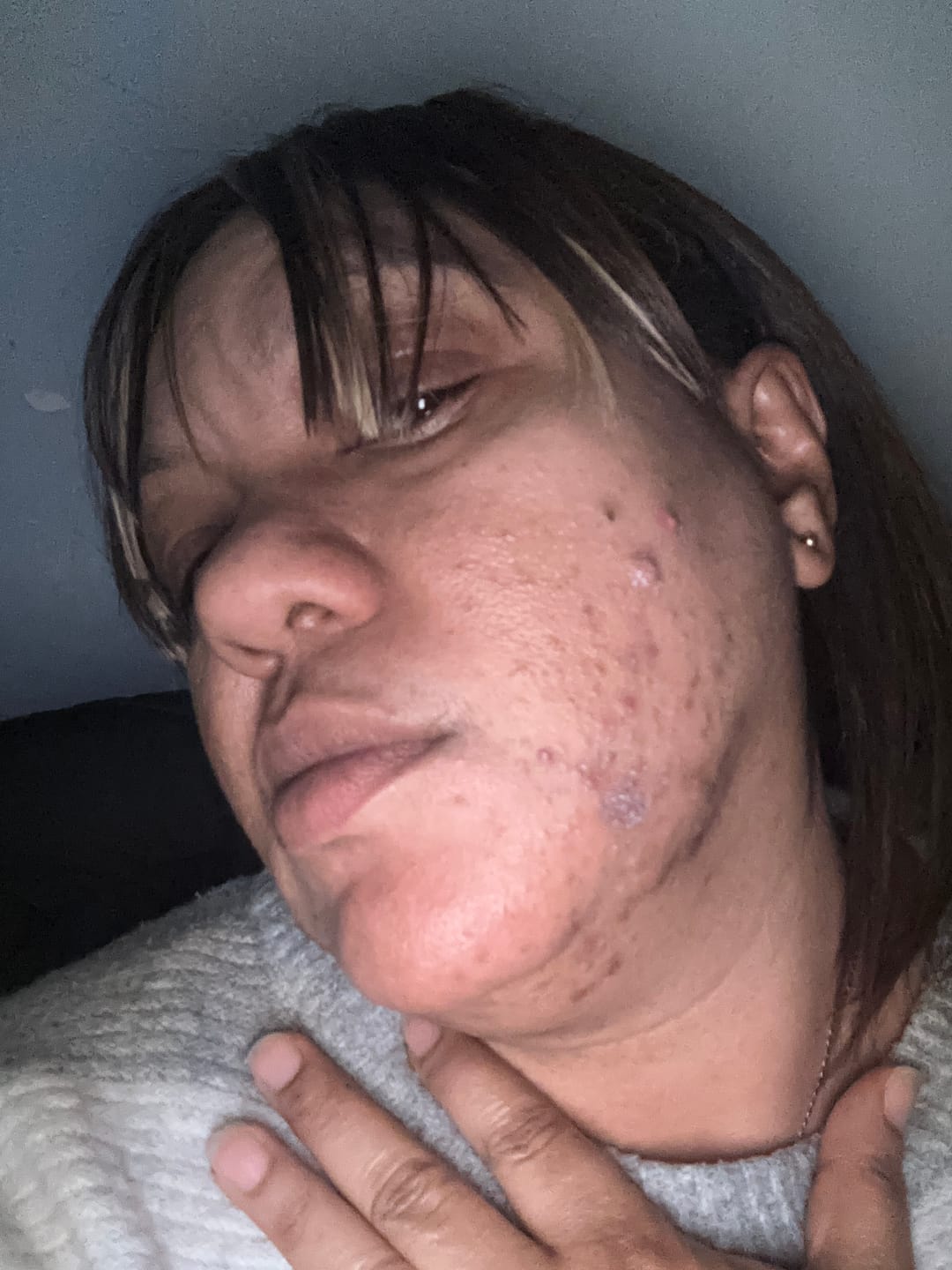 Customer photo review of Salicylic Acid Acne-Clearing 4-Piece Set