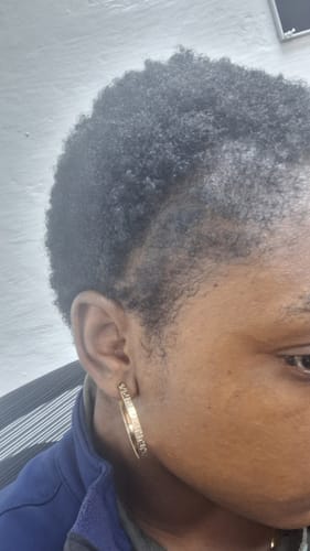 Customer photo review of Minoxidil High Strength (5%) FOAM, 3x60ml pack