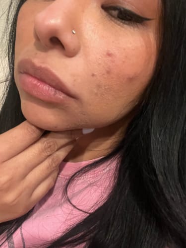 Customer photo review of 1.8% Salicylic Acid Drying Lotion