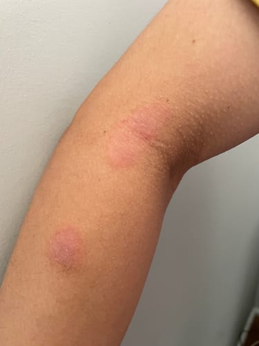 Reviewer's arm showing two red eczema spots mentioned in their review for Hemp Seed Butter.