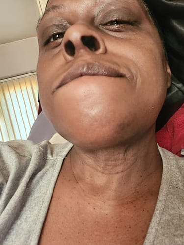 Close-up of a reviewer's face and neck, showing hyperpigmentation being treated with Magix Cream.