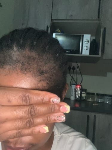 Customer photo review of Minoxidil High Strength (5%) SOLUTION, 3x60ml pack