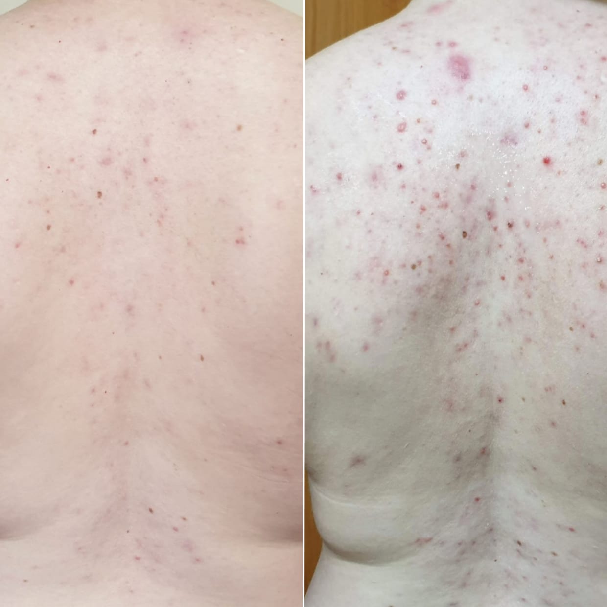 Customer photo review of No Filter / Azelaic Acid 20% w/w Body Moisturiser