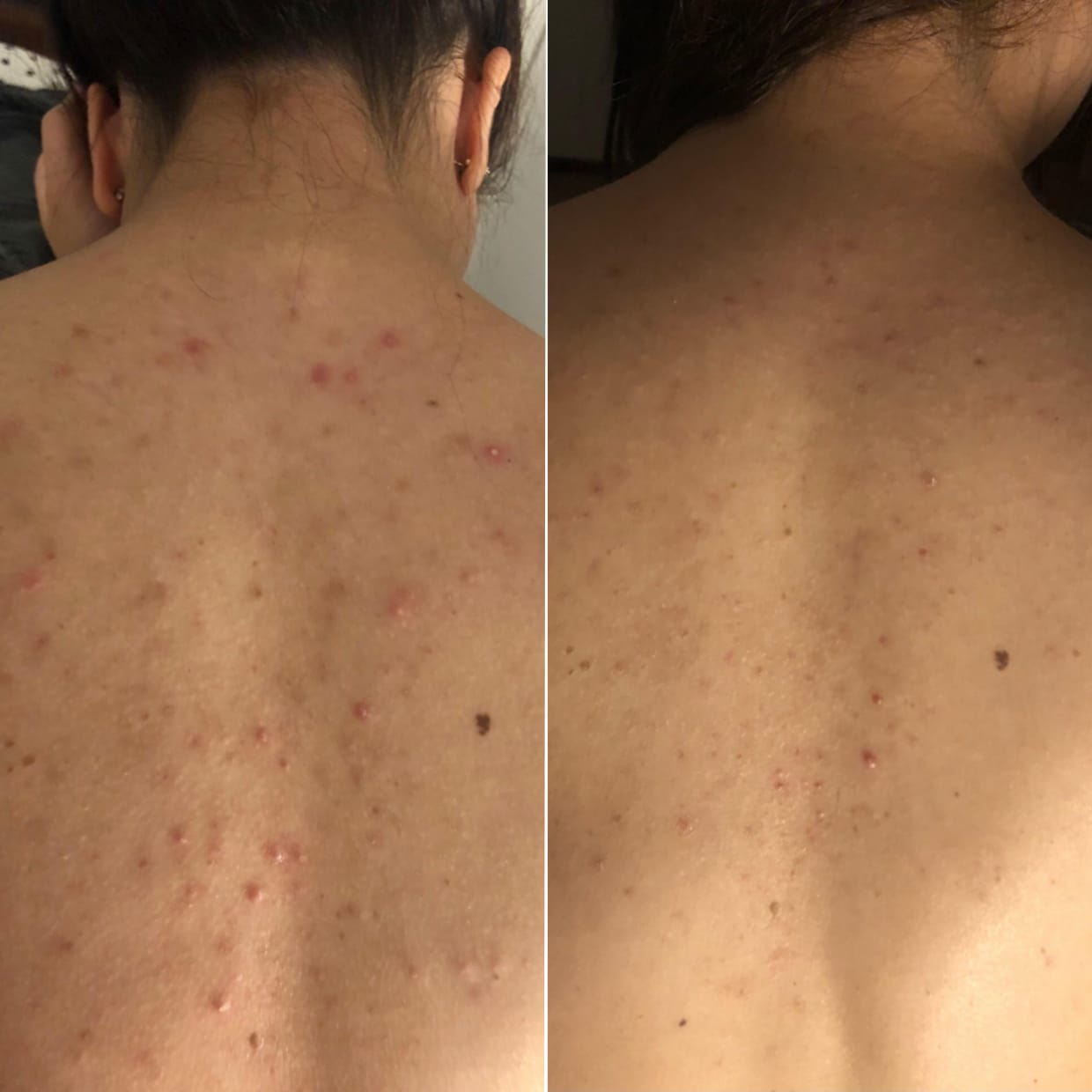 Customer photo review of No Filter / Azelaic Acid 20% w/w Body Moisturiser