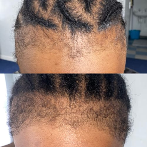 Customer photo review of Minoxidil High Strength (5%) SOLUTION, 3x60ml pack