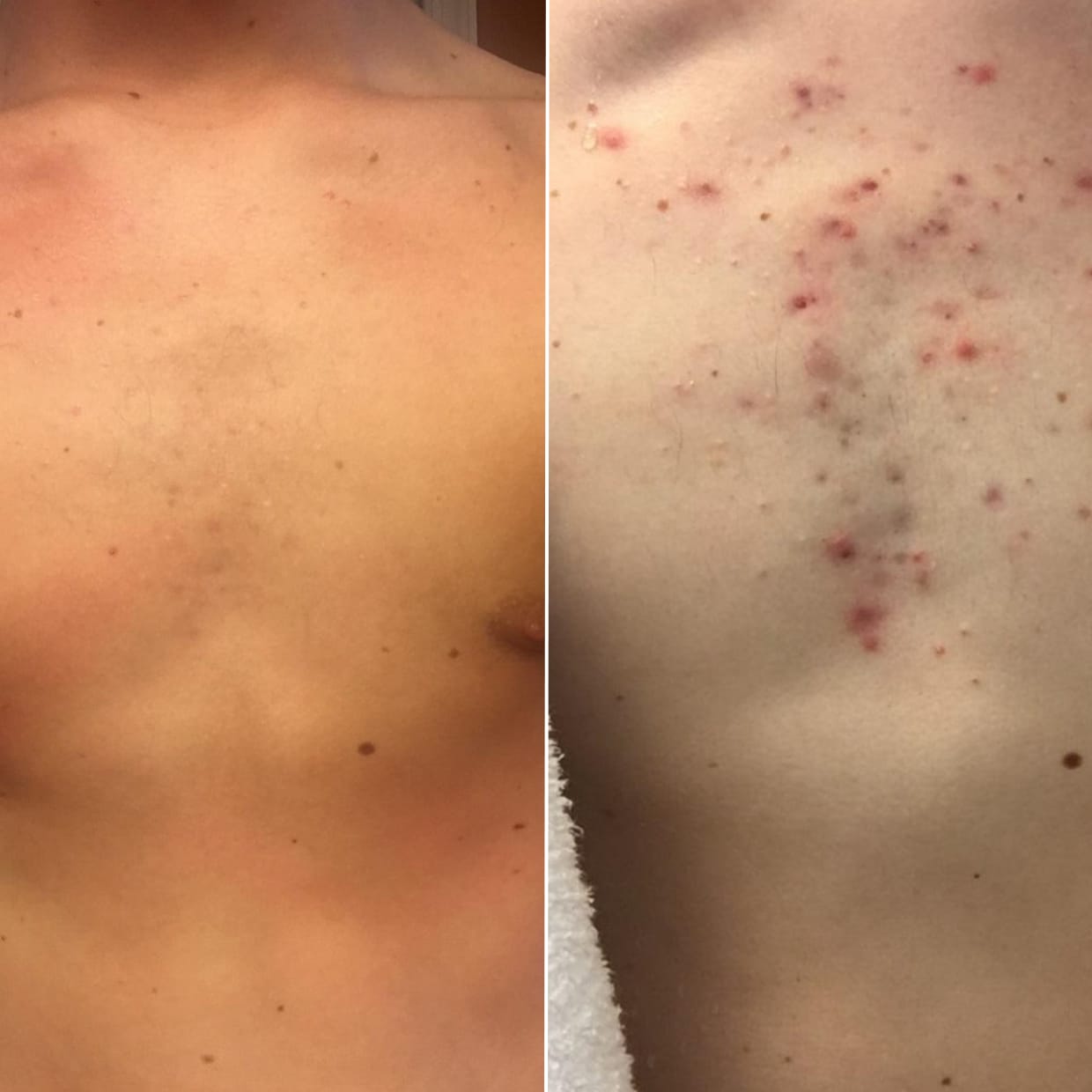 Customer photo review of No Filter / Azelaic Acid 20% w/w Body Moisturiser