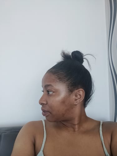 Customer photo review of Minoxidil High Strength (5%) SOLUTION, 3x60ml pack