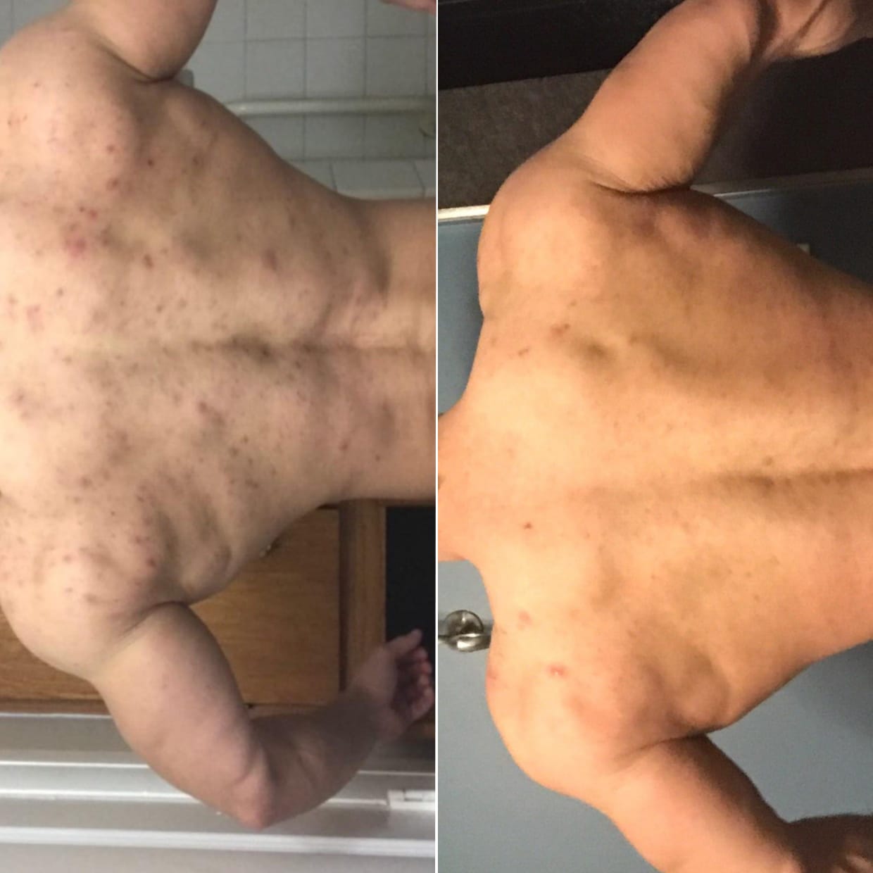 Customer photo review of No Filter / Azelaic Acid 20% w/w Body Moisturiser
