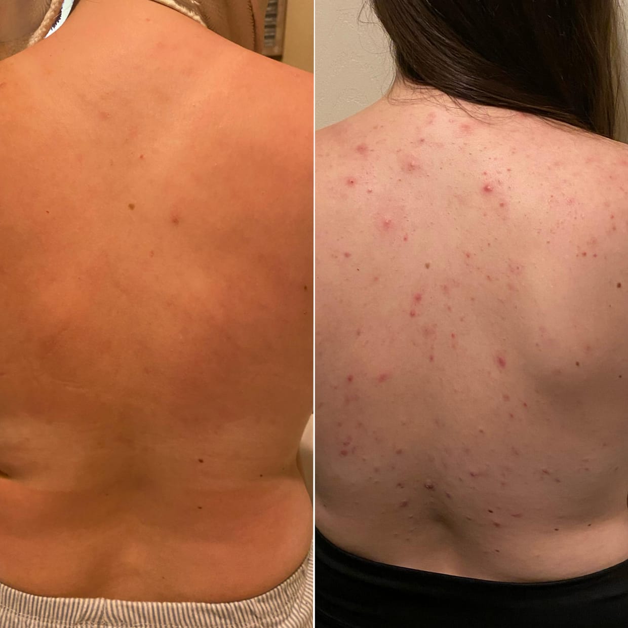 Customer photo review of No Filter / Azelaic Acid 20% w/w Body Moisturiser
