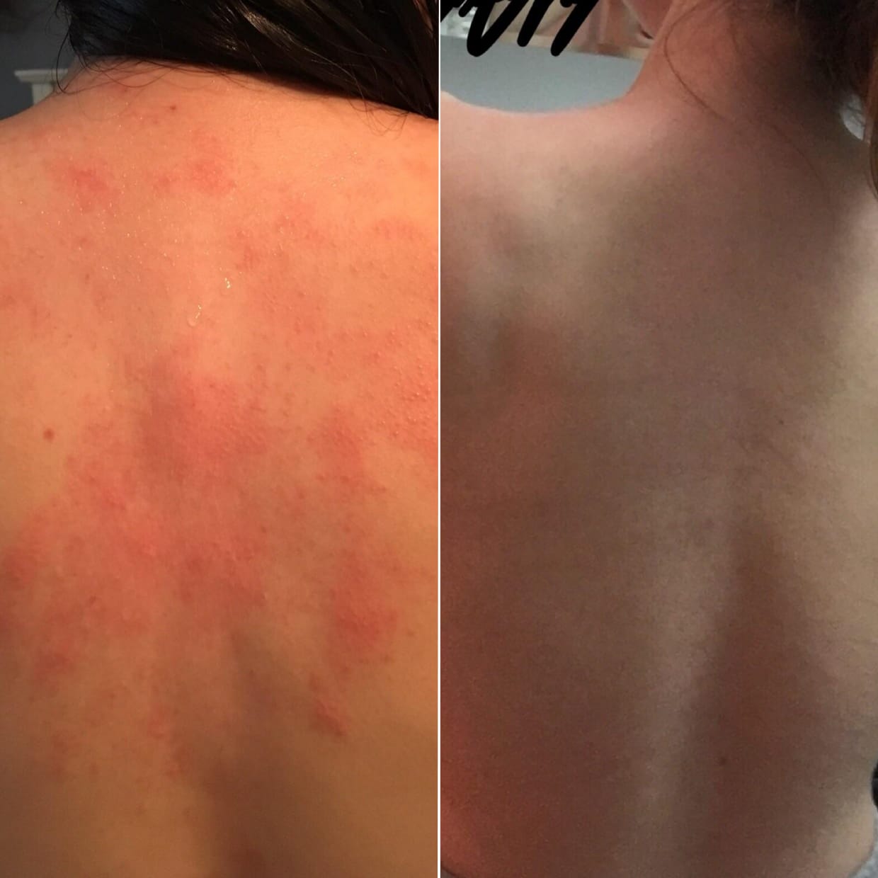 Customer photo review of No Filter / Azelaic Acid 20% w/w Body Moisturiser