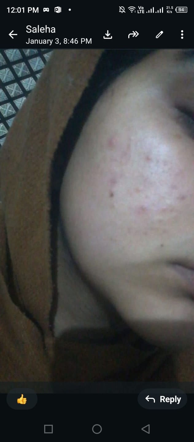 Customer photo review of MandelAC Serum
