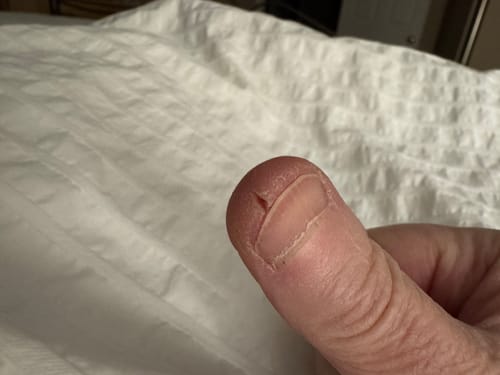 Close-up of a reviewer's thumb with a painful vertical split before using the F-balm.