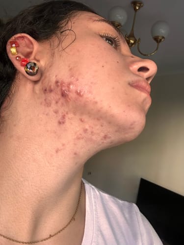 Customer's side profile showing severe acne and redness on their cheek while using the Advanced Acne Program™.