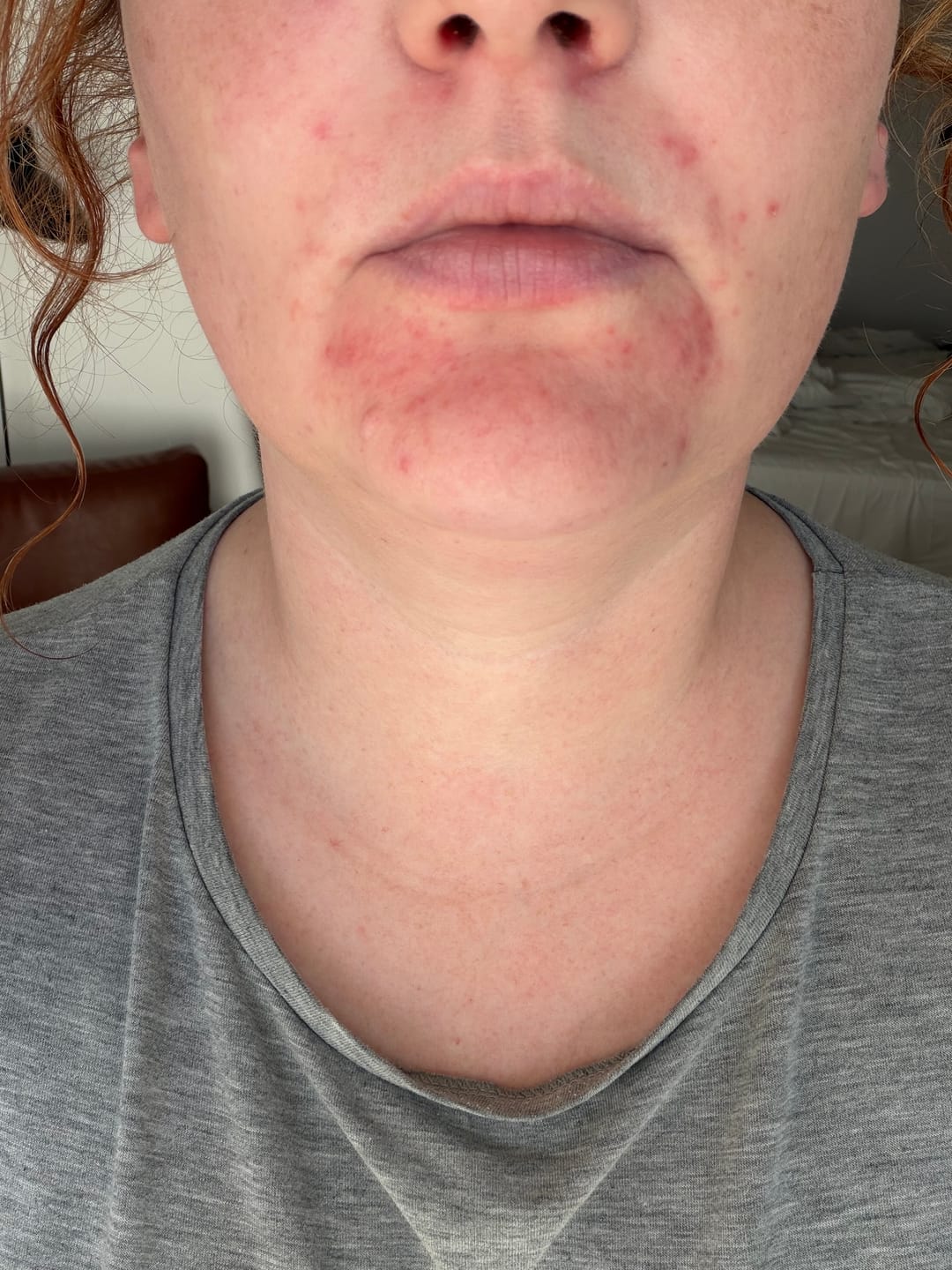 Customer photo review of Antiac Acne Rescue Pack