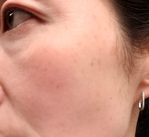 Customer photo review of EvenSkyn® Conduction Gel (300ml) — For Radiofrequency (RF), Ultrasound & Microcurrent Devices