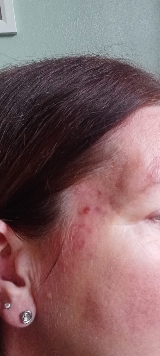 Customer photo review of Kill Acne & Redness Ritual