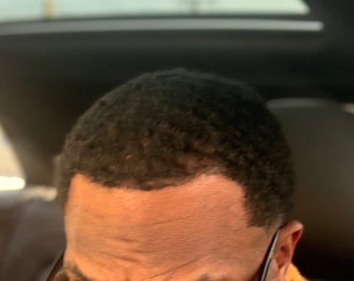 Close-up of a customer's hairline showing thicker hair after using the Rennora Hair Growth Serum.