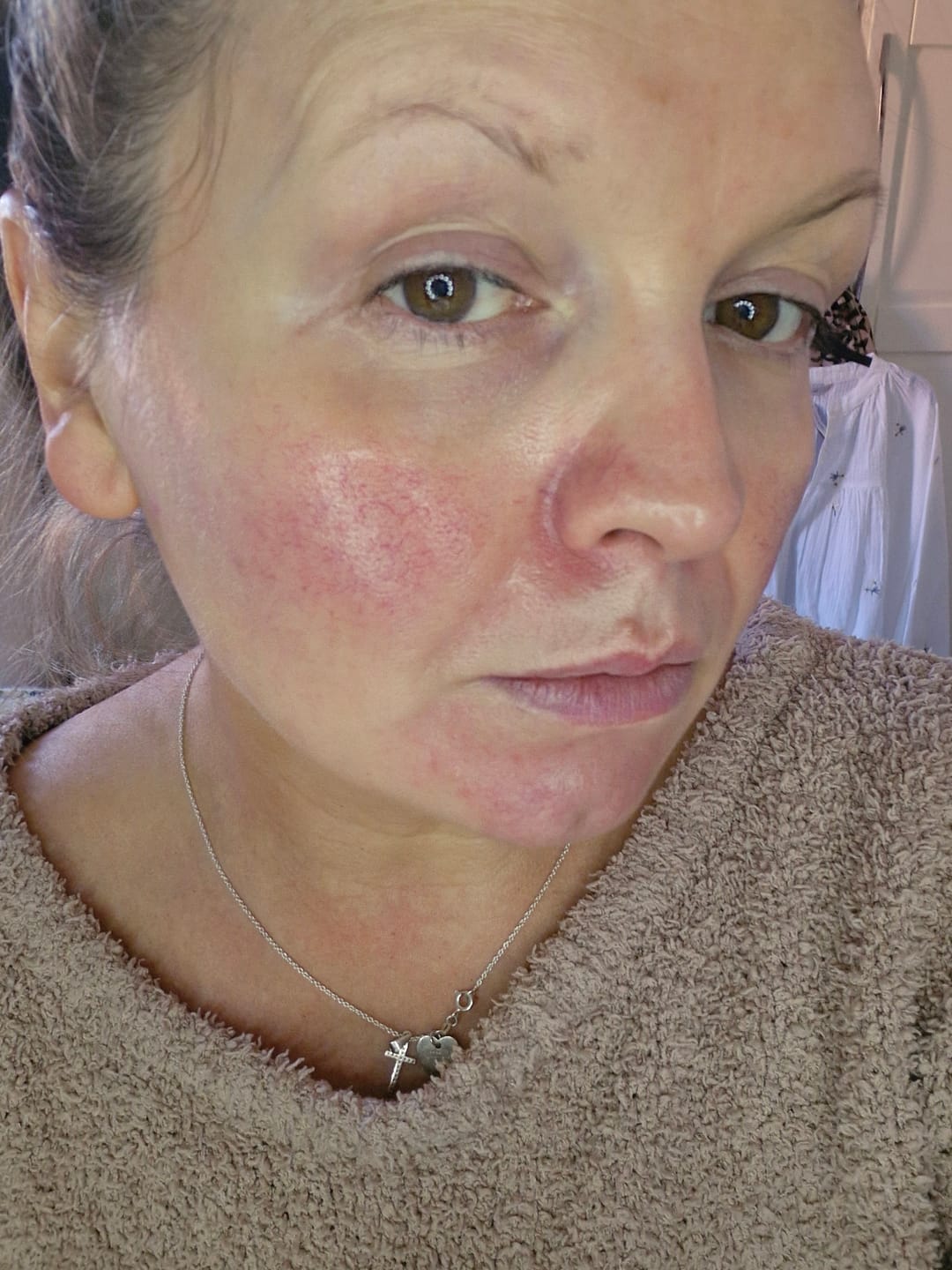Customer photo review of Rosalique 3 in 1 Anti-Redness Miracle Formula SPF50