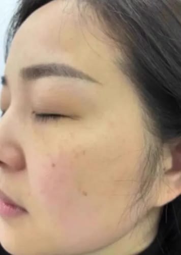 Customer photo review of LUMORA PDRN Renewal Infusion Mask 34ml x 4 sheets