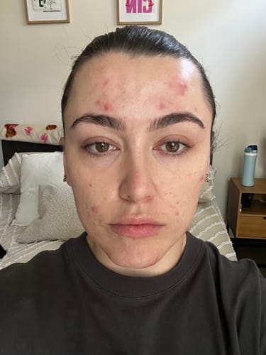Reviewer's face before using the Advanced Acne Program, showing red breakouts on the forehead and cheeks.