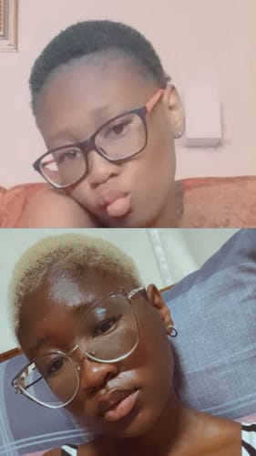 Customer photo review of Minoxidil High Strength (5%) FOAM, 3x60ml pack