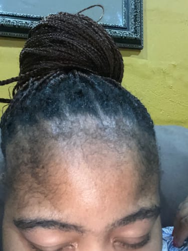 Customer photo review of Minoxidil High Strength (5%) SOLUTION, 3x60ml pack