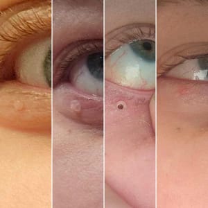 Customer photo review of Bőrkinövés Eltávolító Készlet