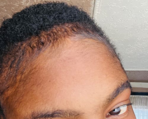 Customer photo review of Minoxidil High Strength (5%) SOLUTION, 3x60ml pack