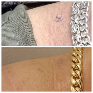 Customer photo review of Bőrkinövés Eltávolító Készlet