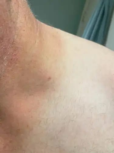 Customer photo review of Bőrkinövés Eltávolító Készlet
