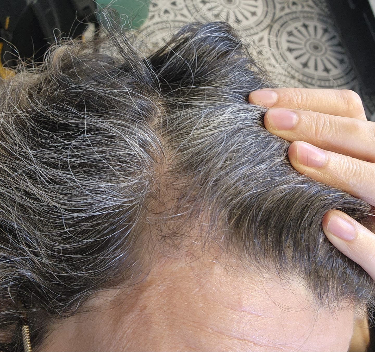 Customer photo review of Hair Loss Prevention Kit
