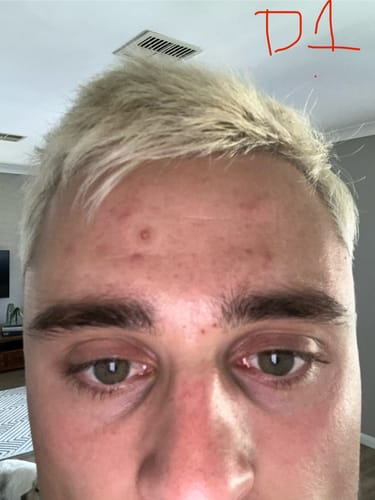 Customer's forehead on Day 1, showing breakouts and redness before using the Starter Acne Program™.