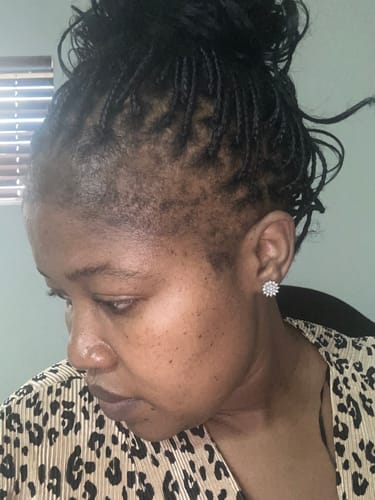 Customer photo review of Minoxidil REGULAR (2%) strength SOLUTION, 3x60ml pack