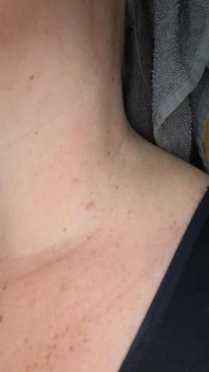 Customer photo review of Bőrkinövés Eltávolító Készlet