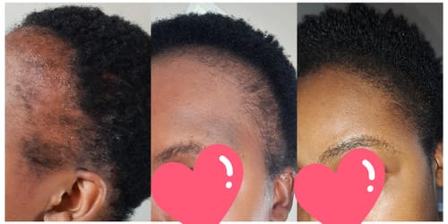 Customer photo review of Minoxidil High Strength (5%) SOLUTION, 3x60ml pack