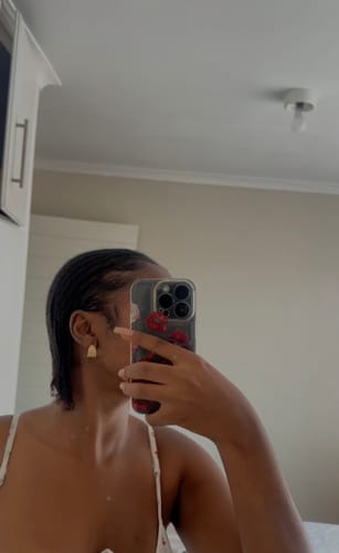 Customer photo review of Minoxidil High Strength (5%) FOAM, 3x60ml pack