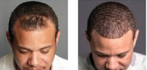 Customer photo review of Minoxidil High Strength (5%) SOLUTION, 3x60ml pack