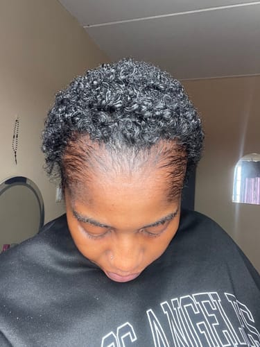 Customer photo review of Minoxidil High Strength (5%) SOLUTION, 3x60ml pack