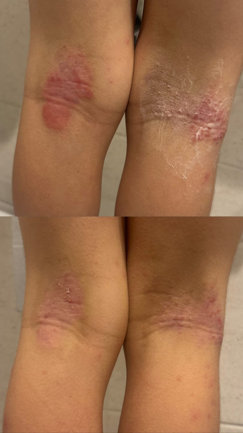 Customer photo review of Bioskin Junior Duo Pack