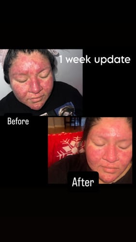 Customer photo review of CLEAR SKIN COMBO (6 products in 1 bundle)