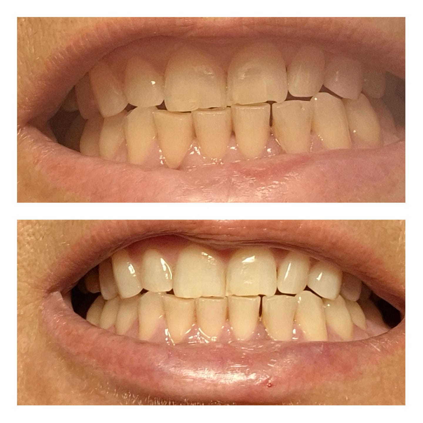 Customer photo review of PAP+ bieliace pásiky na zuby (10 aplikácií)