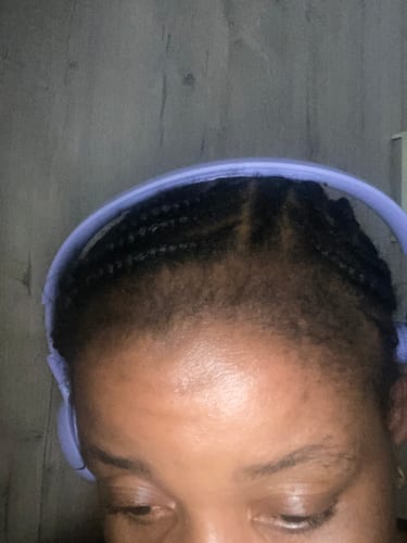 Customer photo review of Minoxidil High Strength (5%) SOLUTION, 3x60ml pack