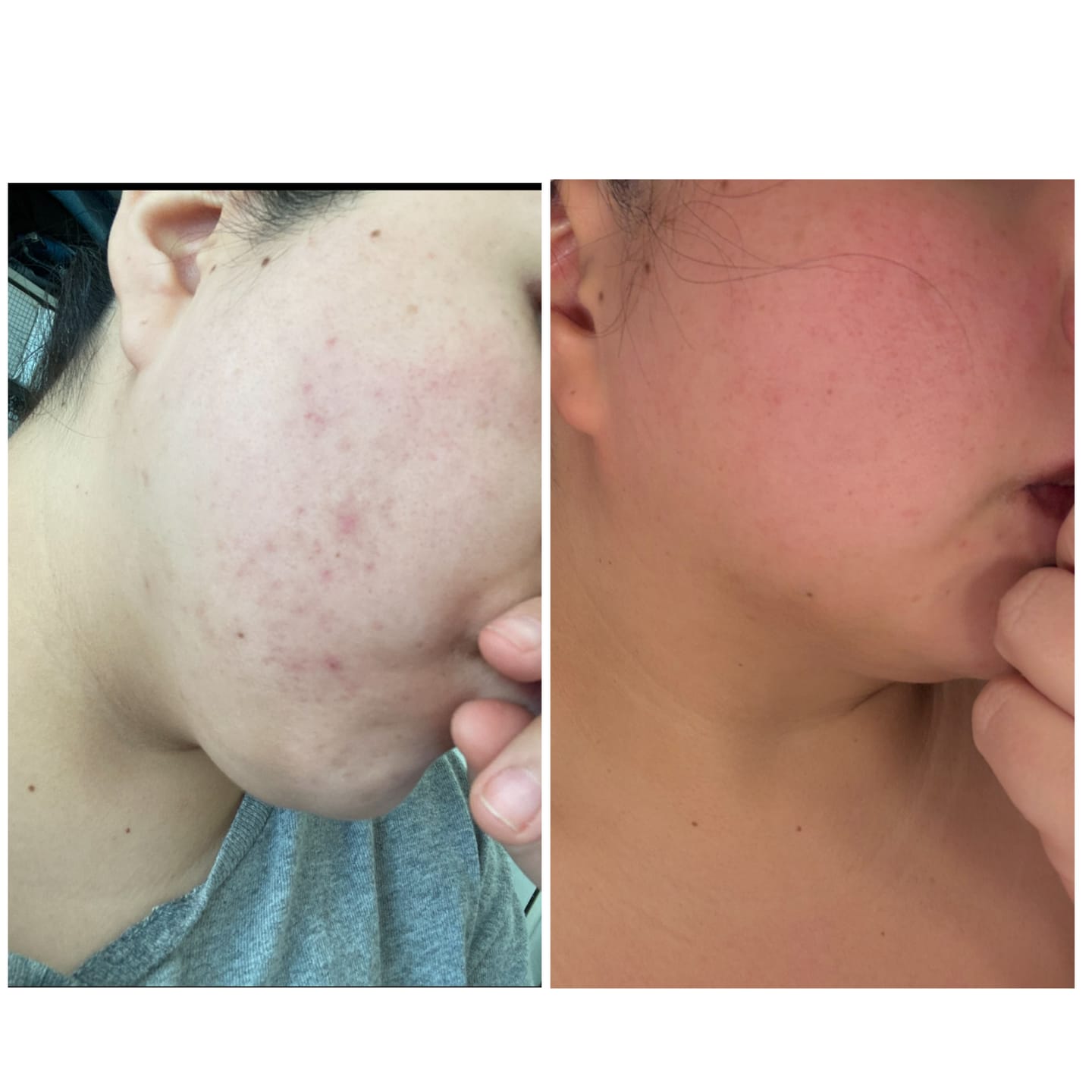 Customer photo review of Antiac Acne Rescue Pack
