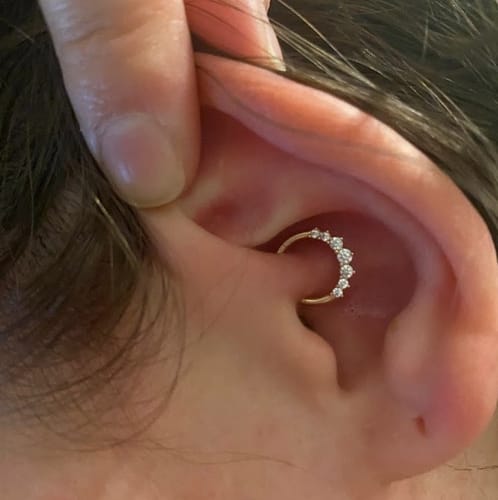 Customer photo review of Piercing Bump Treatment - Bump, Keloid & Scar Relief Oil