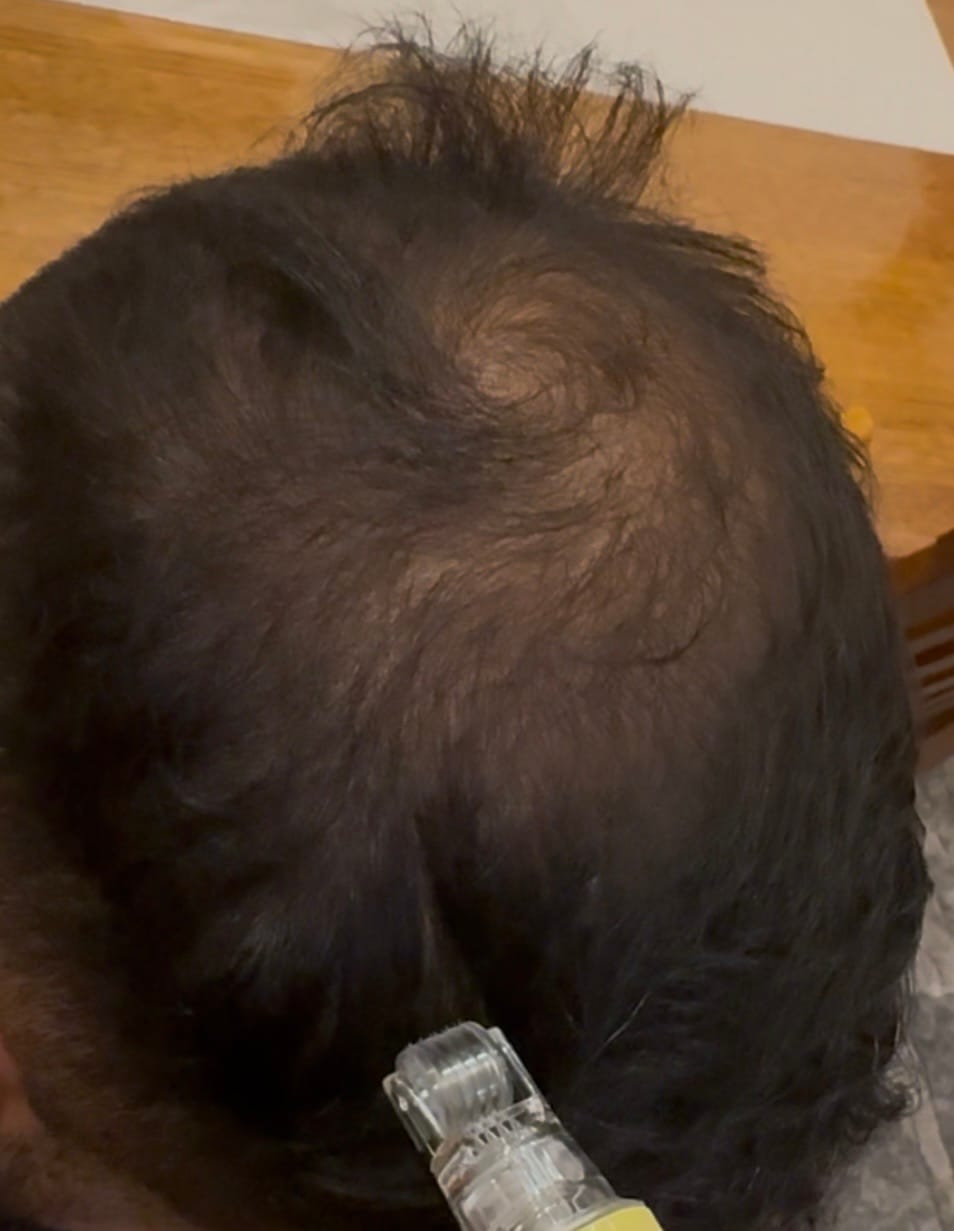 Customer photo review of The Magic Hair Growth Serum with Micro-infusion Applicator