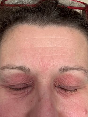 Close-up of reviewer's eyelids showing red, inflamed skin from dermatitis before using the Calm Skin-Relief Kit.