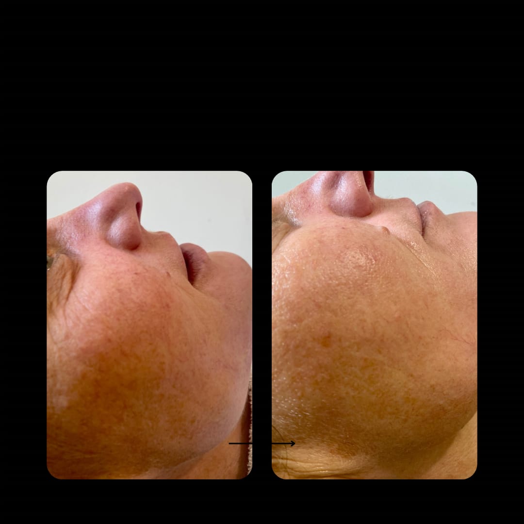 Customer photo review of Seranova Micro Infusion System™
